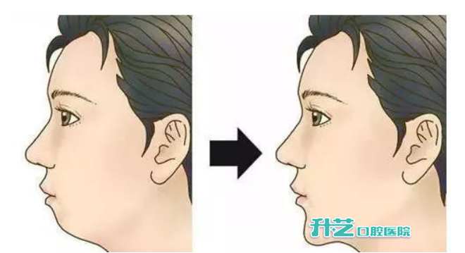 牙齿矫正对哪4类人，改变脸型的影响最大呢？