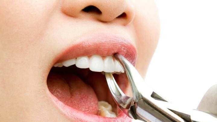 听说矫正牙齿一定要拔牙？还要一次拔4颗？