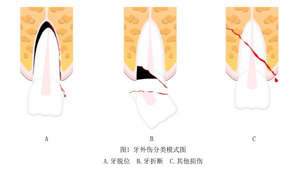 部分脱位和完全脱位几种不同情况,并且常伴有牙龈撕裂与牙槽突骨折