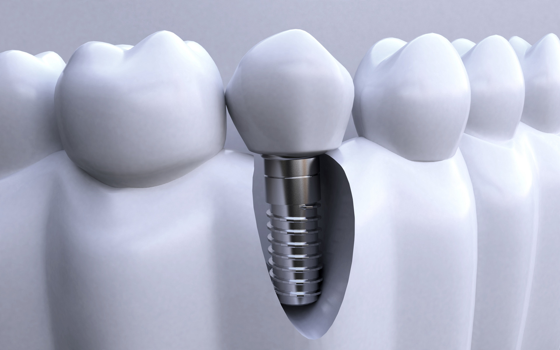 同样用于牙齿正畸，骨钉和附件有什么区别？_斯迈尔齿科(SME)官方网站 - 一次选择 终身相伴
