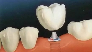 种植牙修复医院专家告诉您：保护种植牙体很重要