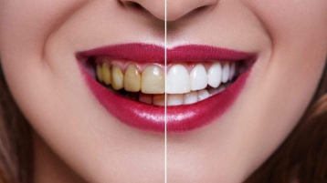 牙齿漂白还是牙齿贴面，美白牙齿修复方法怎么选？