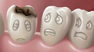 蛀牙从形成到失去牙齿要多久？