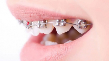中山牙科知识科普丨牙齿矫正的这些坑你知道多少？