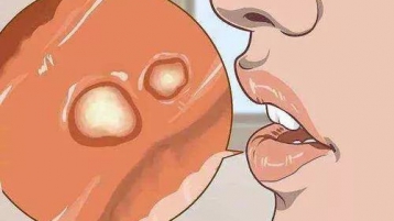 口腔溃疡不能大意！了解这些注意事项有助你恢复口腔健康！