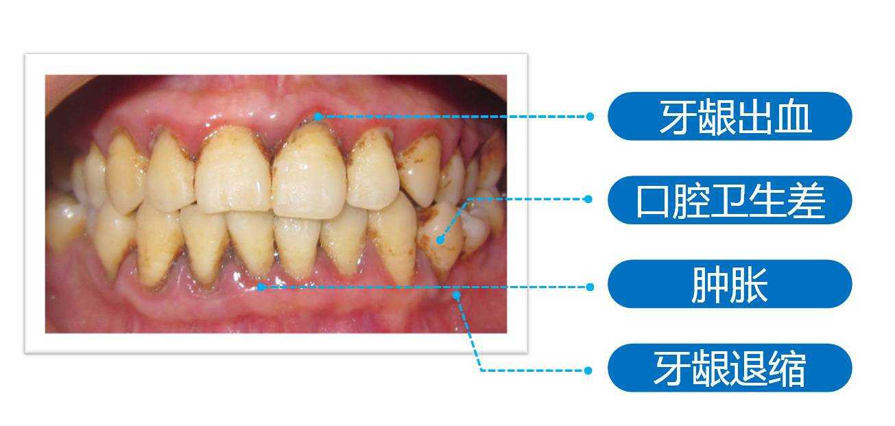 牙周的位置图片图片