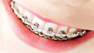 权威牙科专家教你牙齿矫正时，如何选择牙齿矫正器！