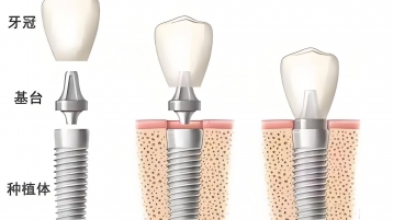 种植牙术后怎么护理？这5件事做错了，可能导致种植失败